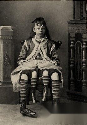 Josephine Myrtle Corbin sinh ra ở Lincoln Township, Tennessee vào năm 1868. Khi mới sinh ra, cô đã bị dị tật đôi hông, nghĩa là cô có xương chậu độc lập ở hai bên eo. Nó giống như chiếc chân thứ ba của Frank Lentini. Hai chiếc chân thừa ban đầu thuộc về một người chị em song sinh khác không được tách rời theo cách thông thường. Hai chân nhỏ hơn ở bên trong nối với đùi bên ngoài để tạo thành một cặp. Người ta nói rằng cô ấy đã từng di chuyển bằng đôi chân bên trong của mình, nhưng chúng quá yếu để đi lại. Myrtle Corbin sinh được bốn con gái và một con trai.
