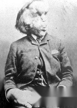 Joseph Merrick sinh năm 1862. Do bị rối loạn thể chất nên chân tay của ông phát triển to bất thường khi mới 5 tuổi. Ông gia nhập một đoàn xiếc vào năm 1884, nơi ông được đối xử tử tế và kiếm được rất nhiều tiền. Người ta còn cử bác sĩ đến thăm khám và sắp xếp mọi việc để anh ấy có cuộc sống tốt hơn. Bây giờ chúng ta biết rằng Joseph Merrick thực sự mắc phải Hội chứng Proteus chứ không phải bệnh chân voi như người ta thường tin vào thời điểm đó. Merrick chết vì ngạt thở khi đang ngủ khi mới 27 tuổi.