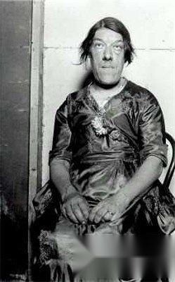 Mary Ann Webster sinh ra ở London, Anh vào năm 1874 trong một gia đình 8 người con. Cô làm y tá khi còn trẻ và sau đó kết hôn với một người bán rau tên là Thomas Bevan vào năm 1903. Nhưng không lâu sau khi kết hôn, Mary Ann bắt đầu xuất hiện các triệu chứng của bệnh to cực. Chứng phì đại liên tục này khiến cô ngày càng phát triển bất thường, khuôn mặt bắt đầu biến dạng, kèm theo đau đầu, suy giảm thị lực và các khớp và cơ... Khi Thomas qua đời năm 1941, họ có 4 người con.