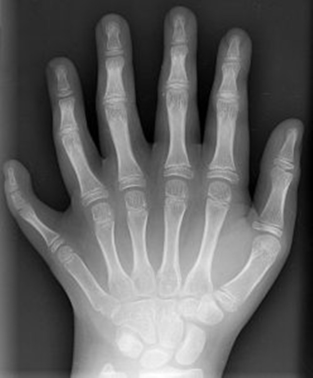 polydactyly-01-lhand-ap-248x300-1707128125.jpg