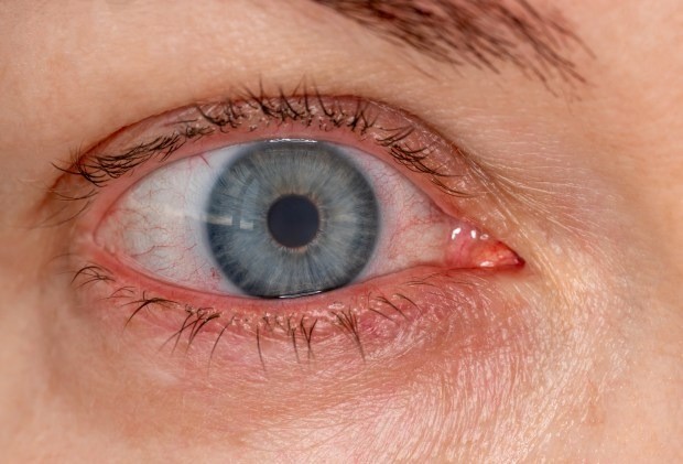 red-inflamed-eye-contact-lens-85-1712978272.jpg