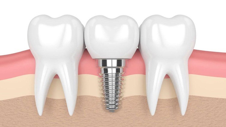 trong-rang-implant-2-1716273085.jpg