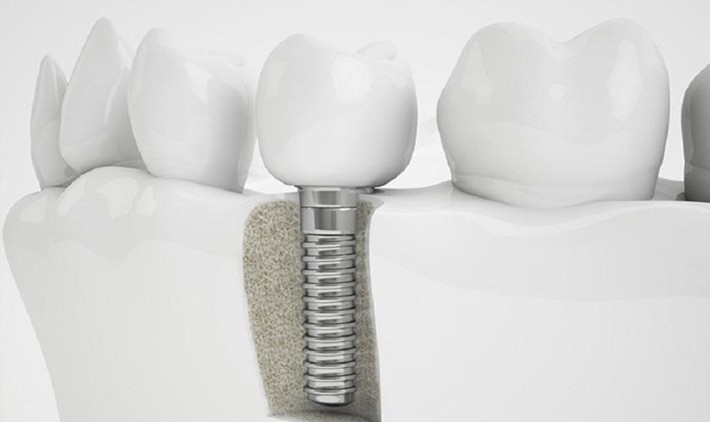 trong-rang-implant-3-1716273085.jpg