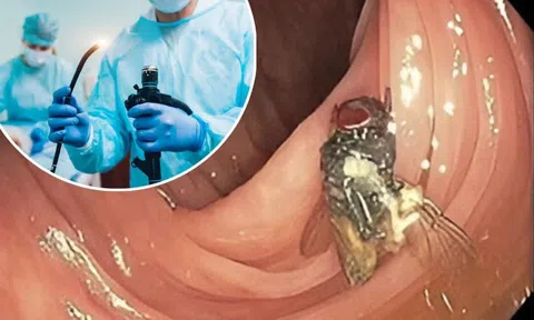 Đi nội soi, người đàn ông bàng hoàng phát hiện trong ruột có loài côn trùng này
