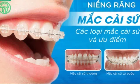 Chi phí niềng răng mắc cài sứ tại nha khoa Đăng Lưu