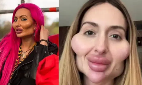 Người phụ nữ có đôi má to nhất thế giới: Tiêm chất làm đầy vào mặt suốt 10 năm trời