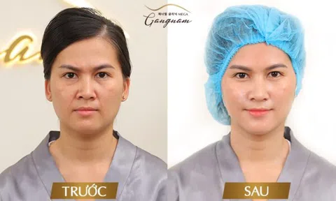 Nâng cơ xoá nhăn - Phương pháp thẩm mỹ tối ưu để giảm thiểu các dấu hiệu của lão hóa da