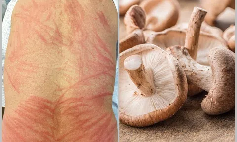 Ăn nấm hương chưa nấu chín, người đàn ông bị phát ban đau đớn suốt hai ngày