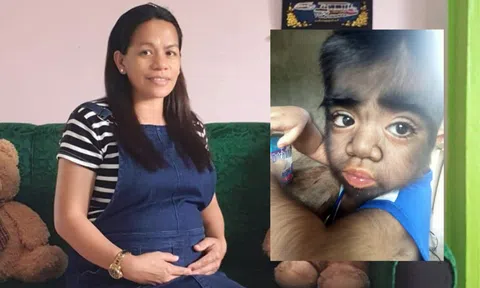 Cậu bé mắc chứng 'người sói' cực hiếm gặp, mẹ hối hận kể câu chuyện kỳ bí lúc mang thai