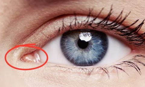 Đi khám vì mắt có dấu hiệu này, cô gái tá hỏa khi phát hiện ký sinh trùng, bác sĩ cũng sững sờ