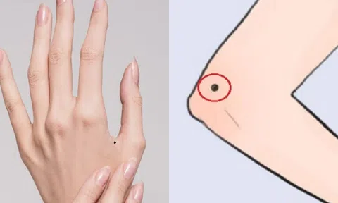 Ba nốt ruồi sẽ giúp bạn giàu có, phát đạt: Một nốt ruồi có ý nghĩa đáng kinh ngạc