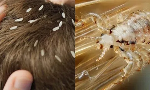 Bất ngờ nguồn gốc của chấy rận hút máu da đầu, nỗi ám ảnh của con người hiện đại