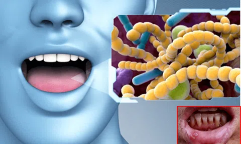 3 dấu hiệu bất thường ở miệng cảnh báo bệnh ung thư ‘gõ cửa’