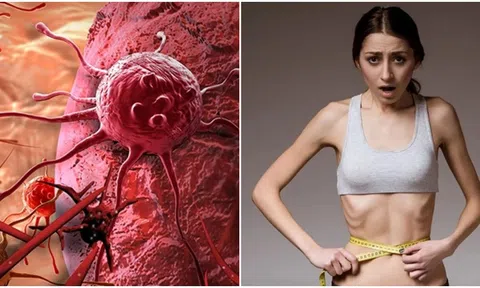 Vì sao tế bào ung thư lại ‘ưu ái’ người gầy và ‘ghét’ người béo?