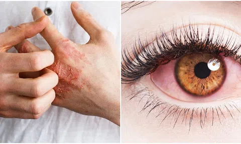 5 người phụ nữ lây bệnh giang mai mắt từ cùng 1 người đàn ông