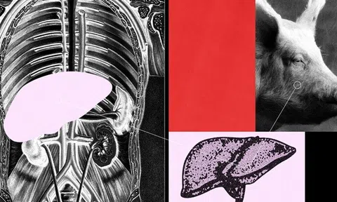 Gan lợn chỉnh sửa gen được ghép thành công vào người