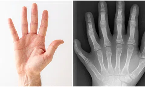 Tại sao con người có 5 ngón tay, ngón chân mà không phải 6 hay 7 ngón?