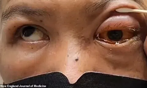 Người đàn ông bị mù vĩnh viễn, vỡ mạch máu trong nhãn cầu sau khi ngủ úp mặt trong lúc say rượu