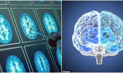 Bật mí sự khác nhau giữa não đàn ông và phụ nữ