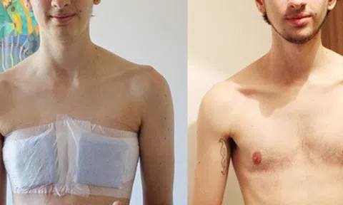 Người chuyển giới dùng testosterone có khả năng mang thai không?