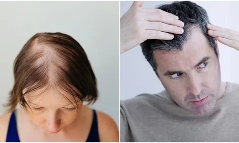 Tại sao con người lại rụng tóc thậm chí bị ‘hói’ khi già đi?