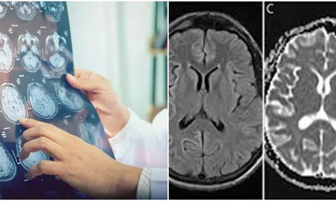 Người phụ nữ 55 tuổi chết vì căn bệnh giống bò điên, tỷ lệ tử vong 100% và chưa rõ nguyên nhân, cách chữa trị