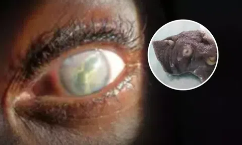 Người phụ nữ phát hiện ký sinh trùng 'giống giun' sống trong mắt suốt hai năm