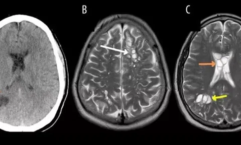 Người đàn ông phát hiện sán dây trong não vì 1 thói quen ăn uống nhiều người mắc phải
