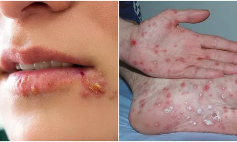 Những triệu chứng bất thường và nghiêm trọng của bệnh giang mai lây truyền qua đường tình dục