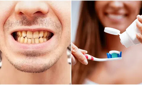 2 lỗi đánh răng phổ biến khiến răng bị ố vàng không phải ai cũng biết