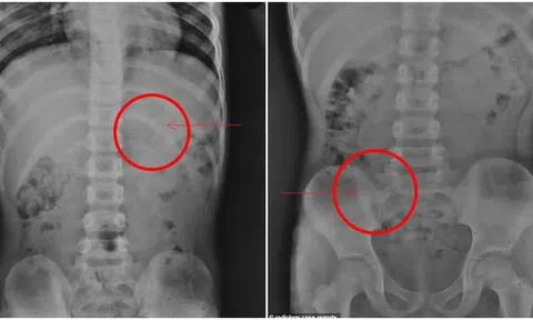 Bé trai 7 tuổi vô tình nuốt cây bút chì 10cm vào bụng, kết quả chụp X-quang gây ngỡ ngàng