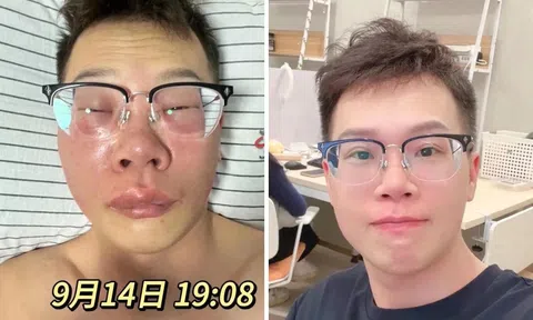 Người đàn ông 33 tuổi sưng phù mặt mũi vì thói quen ngoáy mũi, bác sĩ cảnh báo gay gắt