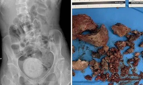 Phát hiện viên sỏi to bằng quả cam trong bụng người phụ nữ, bác sĩ đưa ra cảnh báo khiến ai cũng giật mình