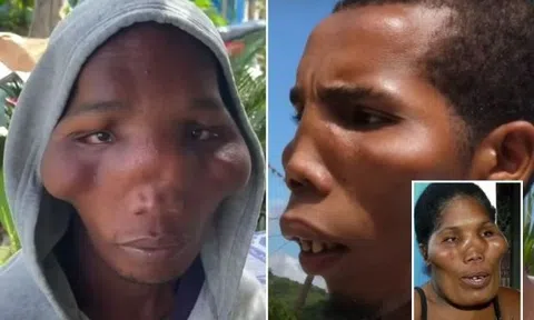 5 người trong một nhà mắc bệnh lạ, mặt biến dạng như người ngoài hành tinh