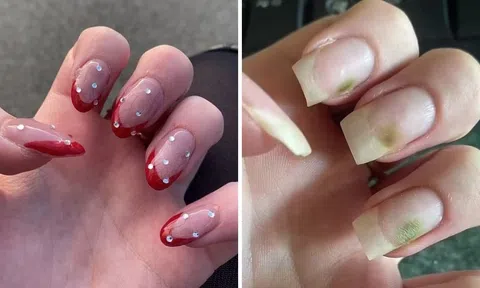 Làm móng acrylic liên tục, cô gái trẻ khủng hoảng vì móng tay mốc xanh