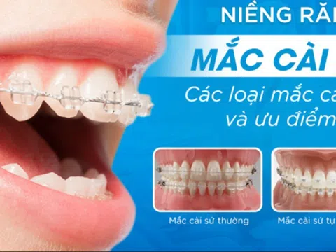 Chi phí niềng răng mắc cài sứ tại nha khoa Đăng Lưu