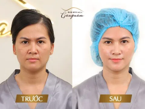 Nâng cơ xoá nhăn - Phương pháp thẩm mỹ tối ưu để giảm thiểu các dấu hiệu của lão hóa da