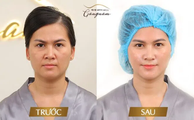 Nâng cơ xoá nhăn - Phương pháp thẩm mỹ tối ưu để giảm thiểu các dấu hiệu của lão hóa da