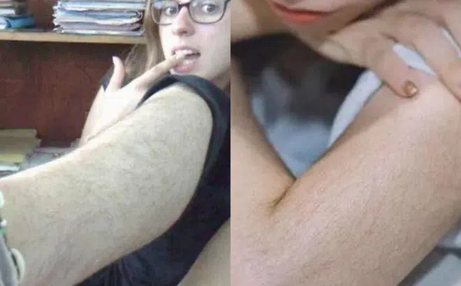 Tại sao nhiều phụ nữ có lông rậm rạp như đàn ông? Phụ nữ nhiều lông hay ít lông khoẻ mạnh hơn?