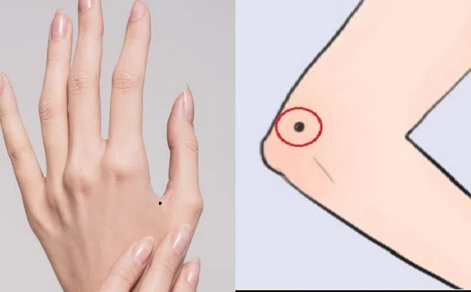 Ba nốt ruồi sẽ giúp bạn giàu có, phát đạt: Một nốt ruồi có ý nghĩa đáng kinh ngạc