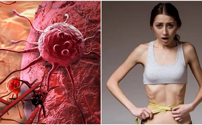Vì sao tế bào ung thư lại ‘ưu ái’ người gầy và ‘ghét’ người béo?