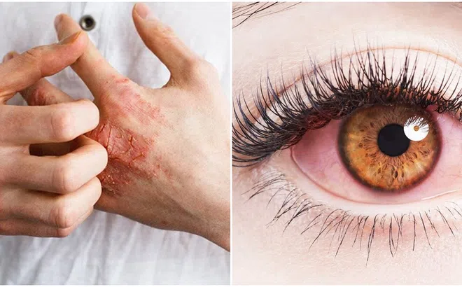 5 người phụ nữ lây bệnh giang mai mắt từ cùng 1 người đàn ông