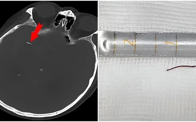 Cụ ông 74 tuổi bất ngờ phát hiện kim châm cứu nằm trong não đã 20 năm khi đi khám bệnh