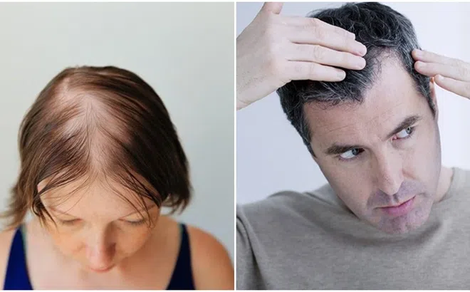 Tại sao con người lại rụng tóc thậm chí bị ‘hói’ khi già đi?