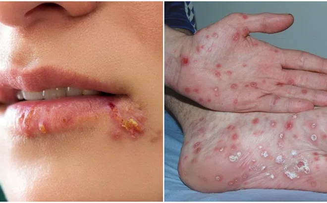 Những triệu chứng bất thường và nghiêm trọng của bệnh giang mai lây truyền qua đường tình dục