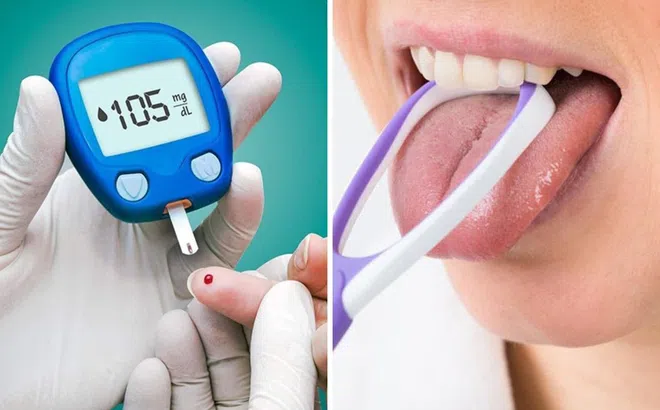 Muốn biết đường huyết cao hay thấp, nhìn vào lưỡi xem có 3 dấu hiệu này không