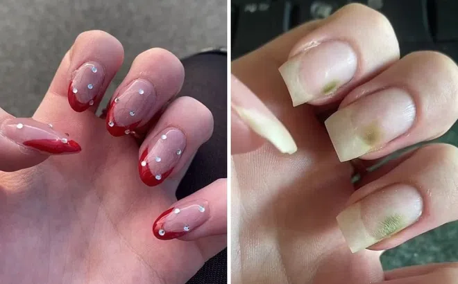Làm móng acrylic liên tục, cô gái trẻ khủng hoảng vì móng tay mốc xanh